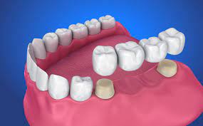 best crown & bridges indirapuram